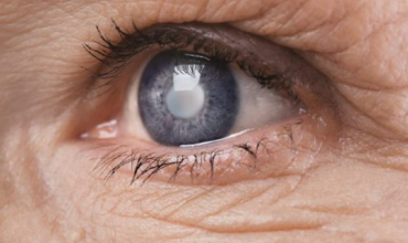 Estudo OHTS revela que cirurgia de Catarata reduz a Pressão Intraocular (PIO)