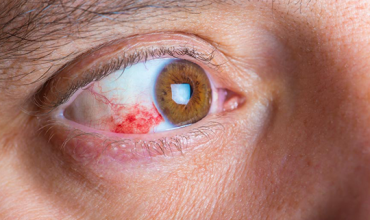 Tratamento para Retinopatia na prematuridade