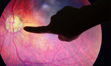 Deslocamento de retina: fique atento aos sinais