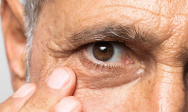 Glaucoma, uma doença silenciosa