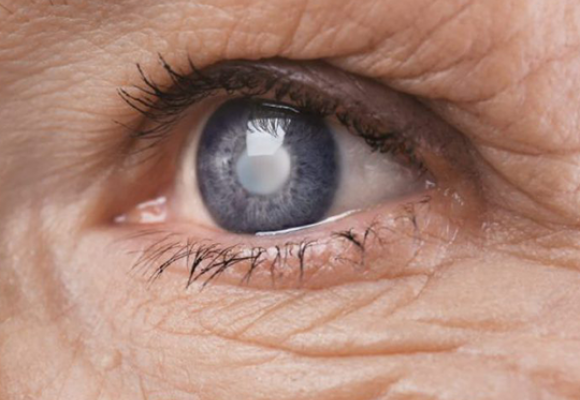 Estudo OHTS revela que cirurgia de Catarata reduz a Pressão Intraocular (PIO)