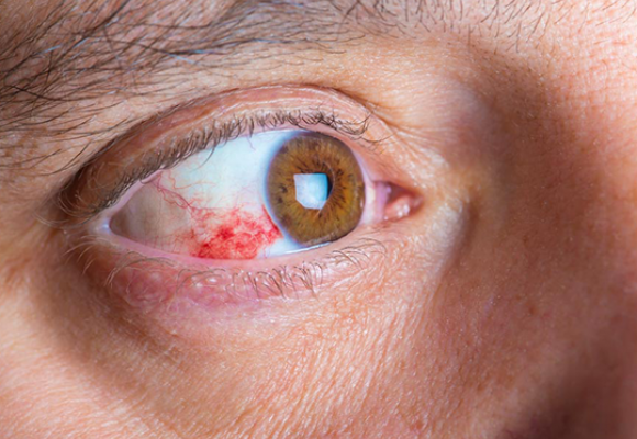 Tratamento para Retinopatia na prematuridade