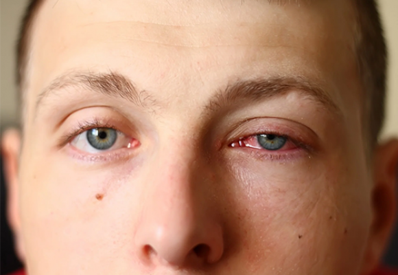 Alergias oculares afetam 15% da população