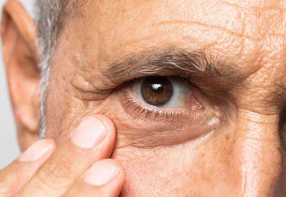 Glaucoma, uma doença silenciosa