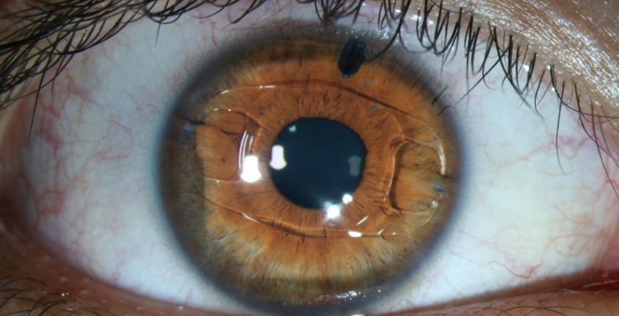 IMPLANTE DE LENTE INTRA-OCULAR ARTISAN