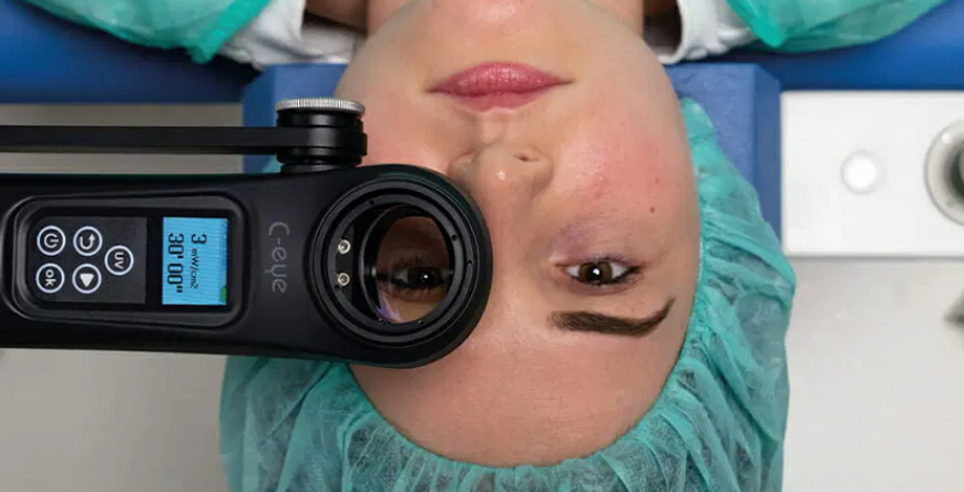 CORNEAL CROSS LINKING