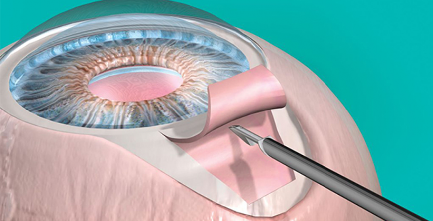 CIRURGIA DE TRABECULECTOMIA